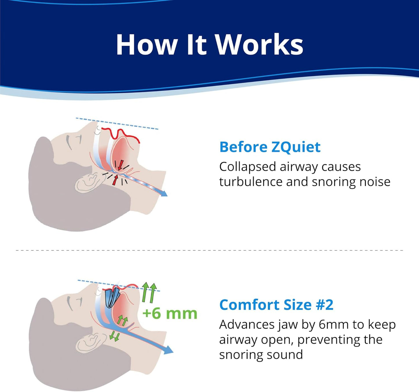 TrueAmorre Comfort Snoring Solution
